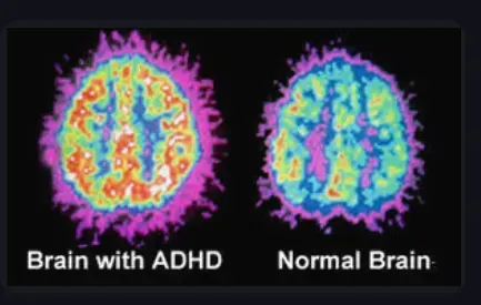Brain scans, ADHD vs. normal. ADHD scan shows more activity, with varied colors. Normal brain scan shows less activity.