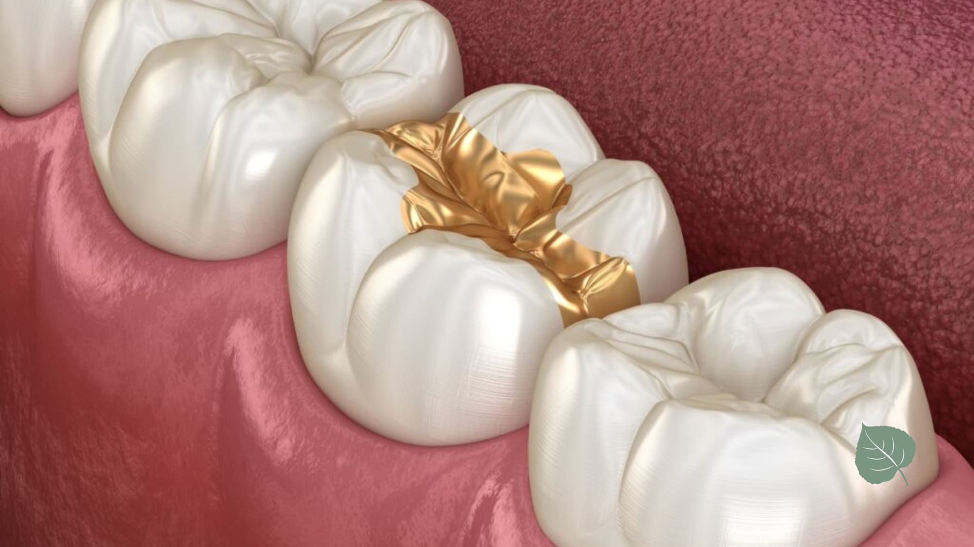 A close up of a row of teeth with gold fillings in them.