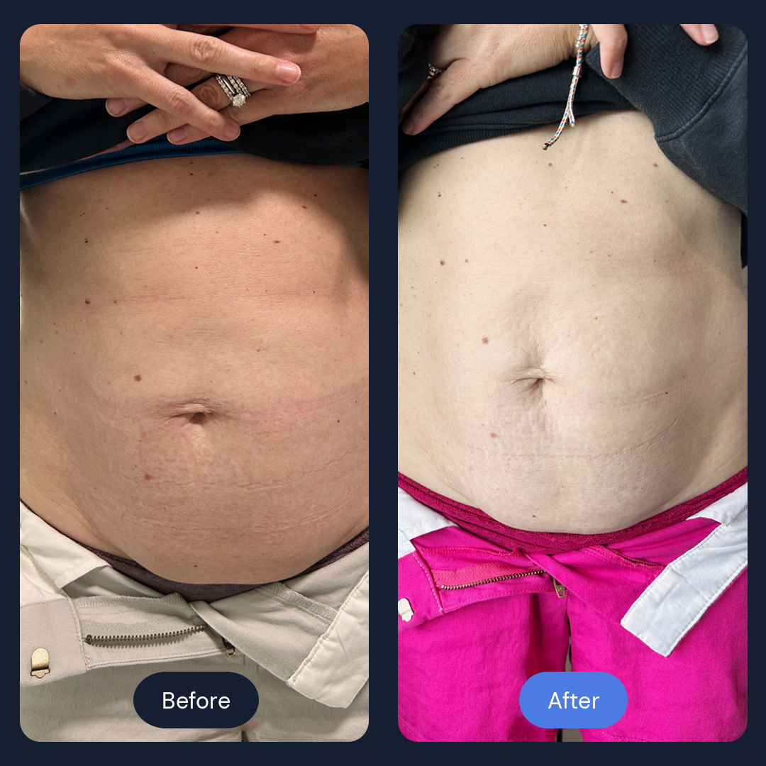 Before & After Gallery | Beauty Bar Wellness & Med Spa | Covington, GA