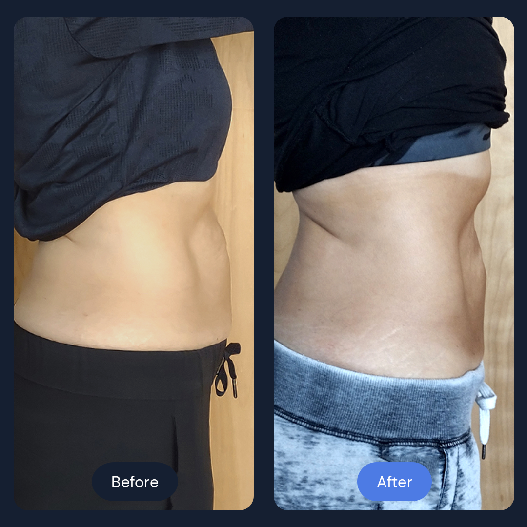 Before & After Gallery | Beauty Bar Wellness & Med Spa | Covington, GA