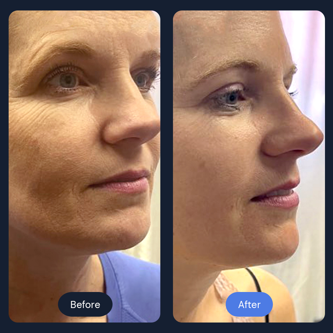 Before & After Gallery | Beauty Bar Wellness & Med Spa | Covington, GA