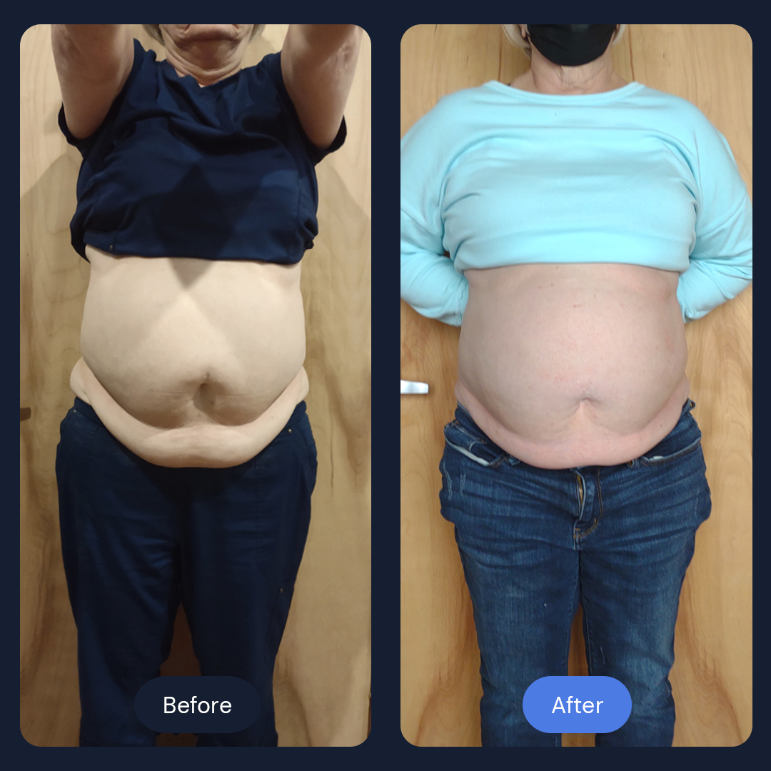 Before & After Gallery | Beauty Bar Wellness & Med Spa | Covington, GA