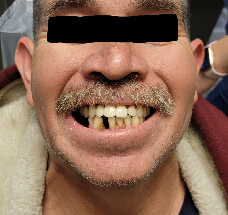 Close-up of a smiling man with a missing front tooth and a black bar covering his eyes.