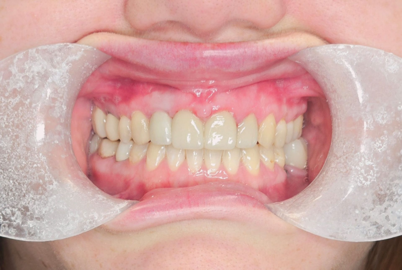 Close-up of teeth with cheek retractors, showing gums and dental alignment