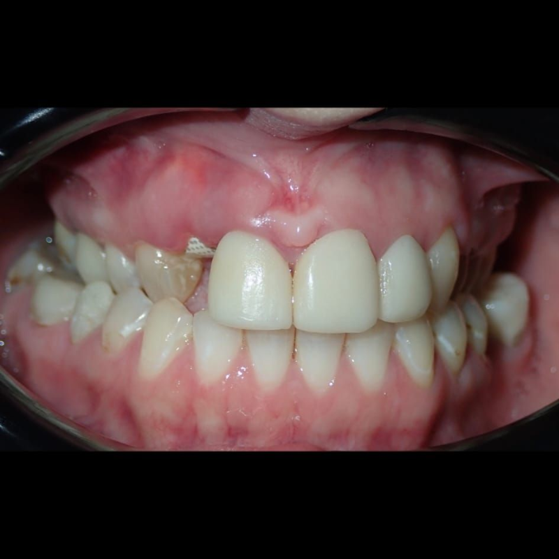 Close-up of teeth and gums showing crowded front teeth and a gap near the upper front teeth