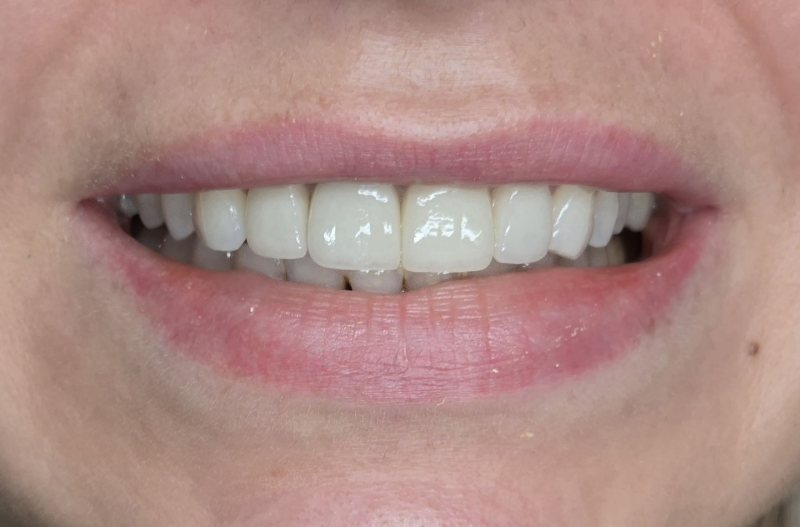 Close-up of a smiling mouth showing white teeth and pink lips