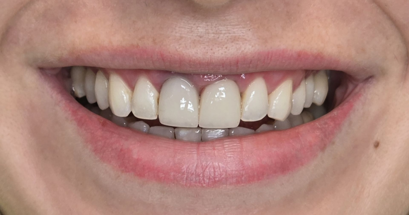 Close-up of a smiling mouth with teeth visible and pink lips