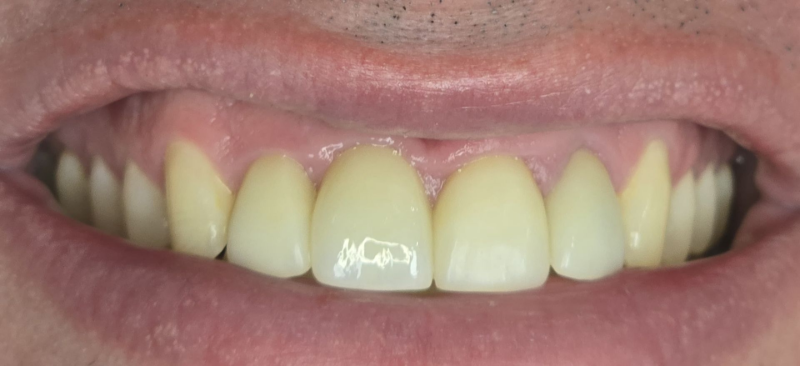 Close-up of a smiling mouth with yellowed teeth and a bright white front tooth