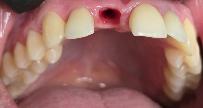 Close-up of an upper mouth with two front teeth missing and a visible gap in the gums