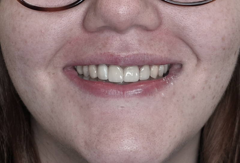Close-up of a smiling mouth with braces and glasses visible above the nose