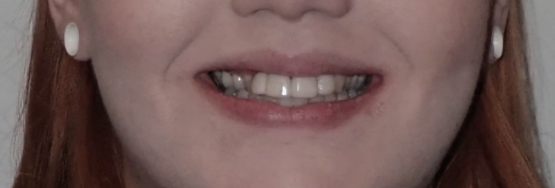Close-up of a smiling mouth showing teeth, with red hair visible at the sides.