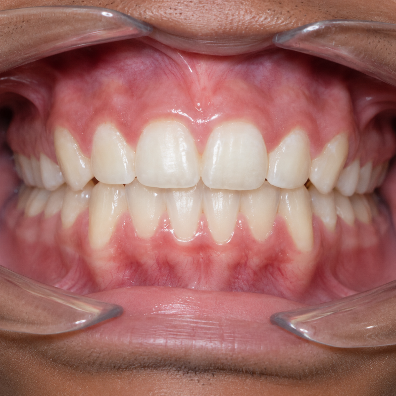Open mouth showing straight white teeth and pink gums with cheek retractors in place