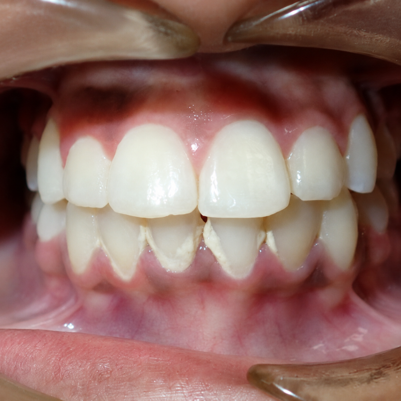 Close-up of teeth and gums, showing a bite with a slight gap between the upper front teeth and lower teeth.
