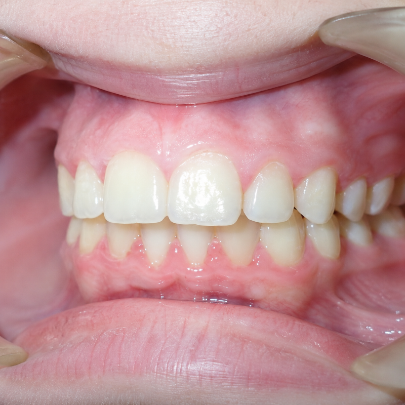 Close-up of a person’s teeth and gums, lips pulled back to show a dental bite alignment.
