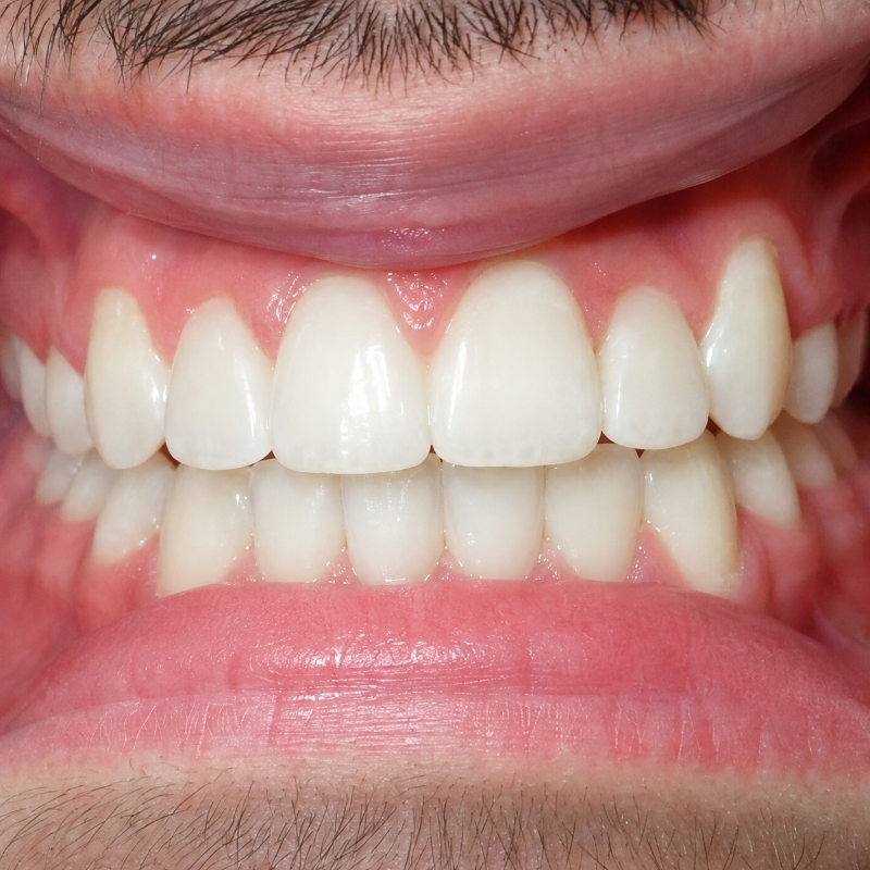 Close-up of teeth and gums, showing a bite with a slight gap between the upper front teeth and lower teeth.