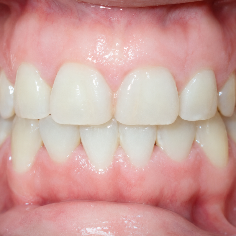 Close-up of a person’s teeth and gums, lips pulled back to show a dental bite alignment.