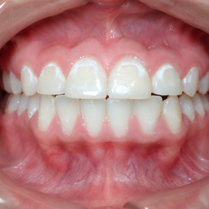 Close-up of a person's mouth showing teeth and gums with braces-free smile