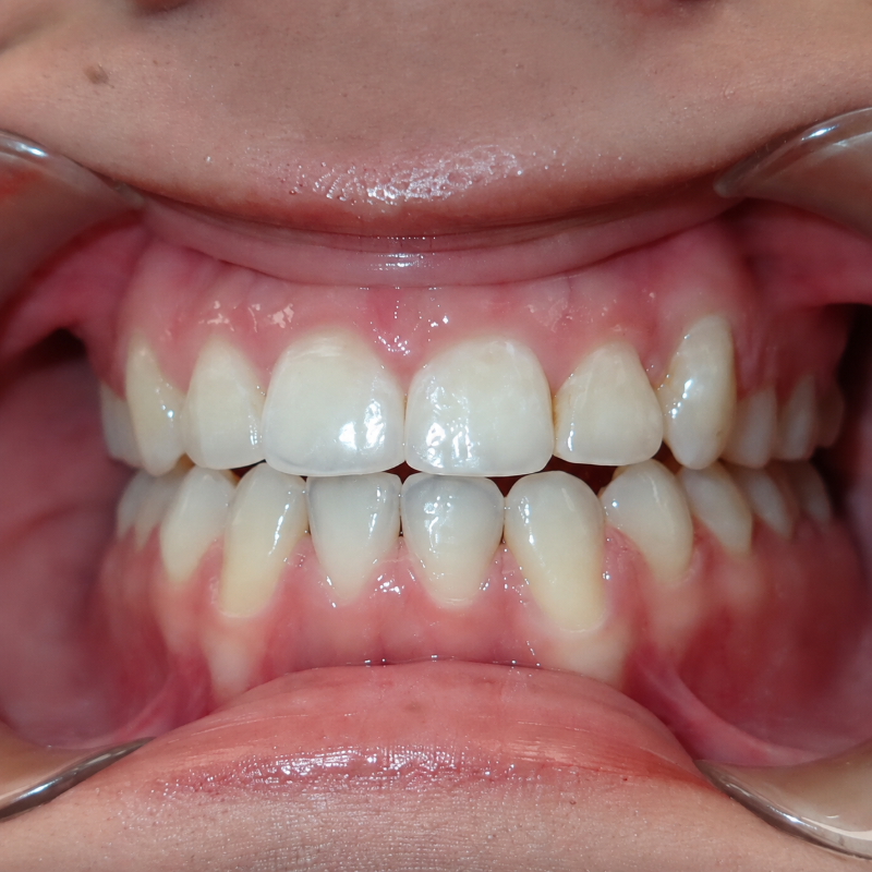 Close-up of teeth with braces impression or dental aligner fitting, upper and lower teeth visible