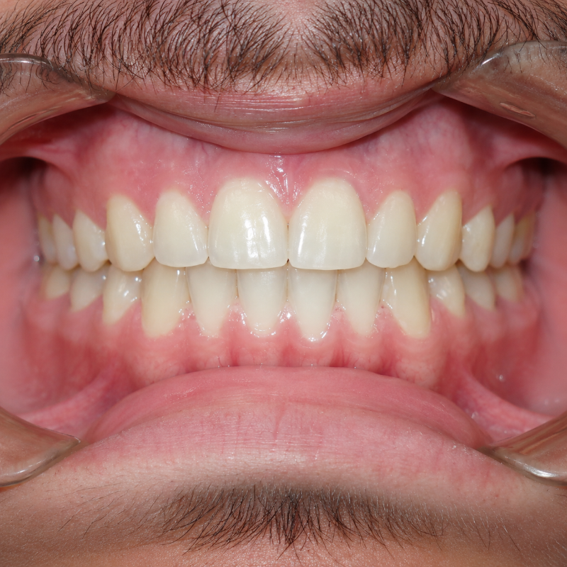 Close-up of a person’s teeth and gums, lips pulled back to show a dental bite alignment.