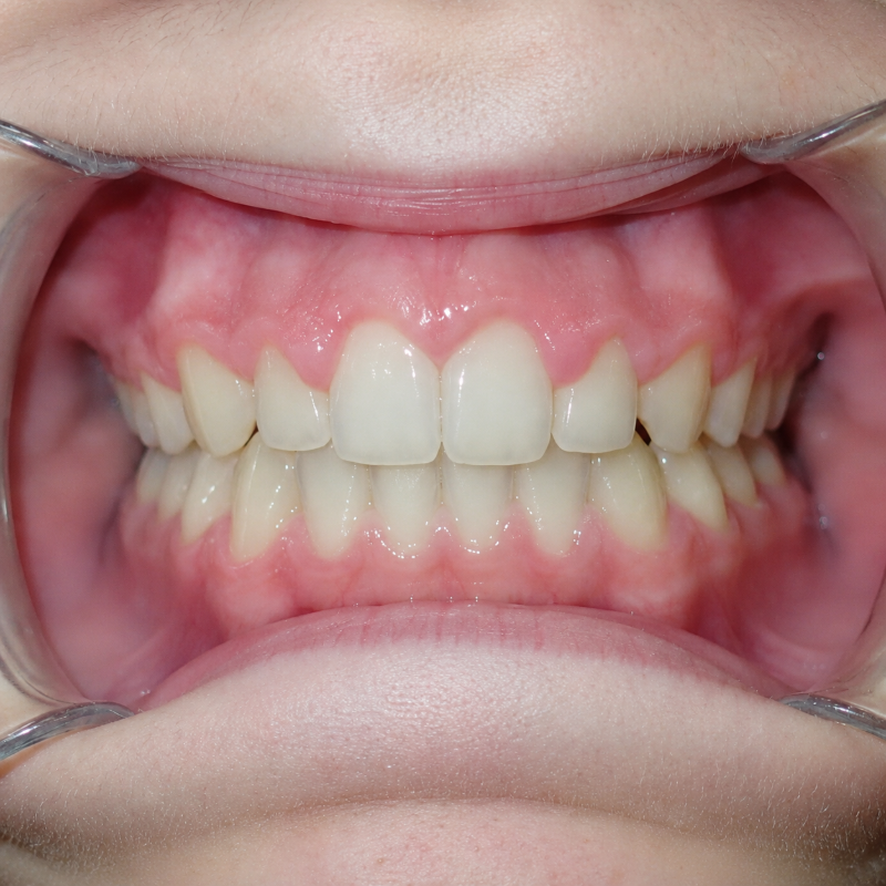 Close-up of teeth with braces impression or dental aligner fitting, upper and lower teeth visible