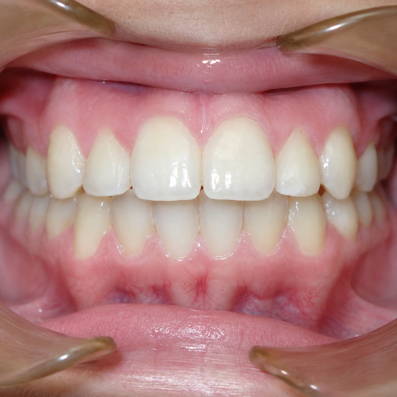 Close-up of a person’s teeth and gums, lips pulled back to show a dental bite alignment.