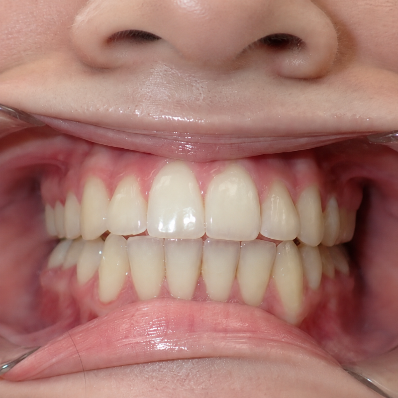 Close-up of teeth with braces impression or dental aligner fitting, upper and lower teeth visible