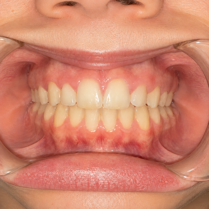 Close-up of a person’s teeth and gums, lips pulled back to show a dental bite alignment.