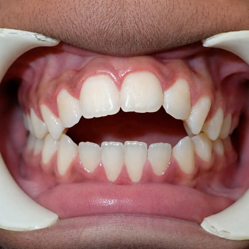 Open mouth showing upper and lower teeth with a noticeable gap between the front teeth, held open with retractors