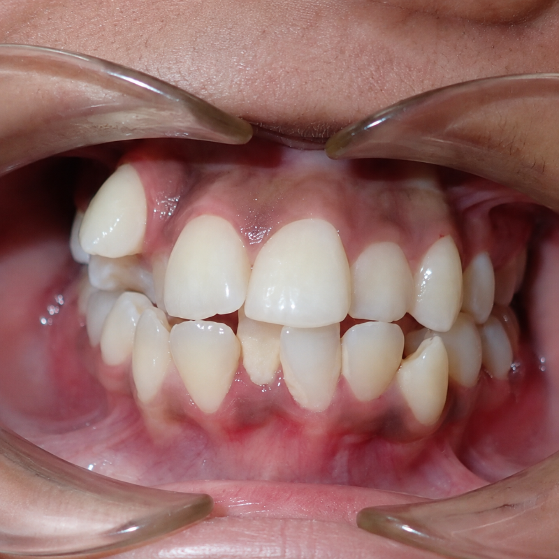 Close-up of a mouth with lips retracted, showing teeth and gums during a dental exam