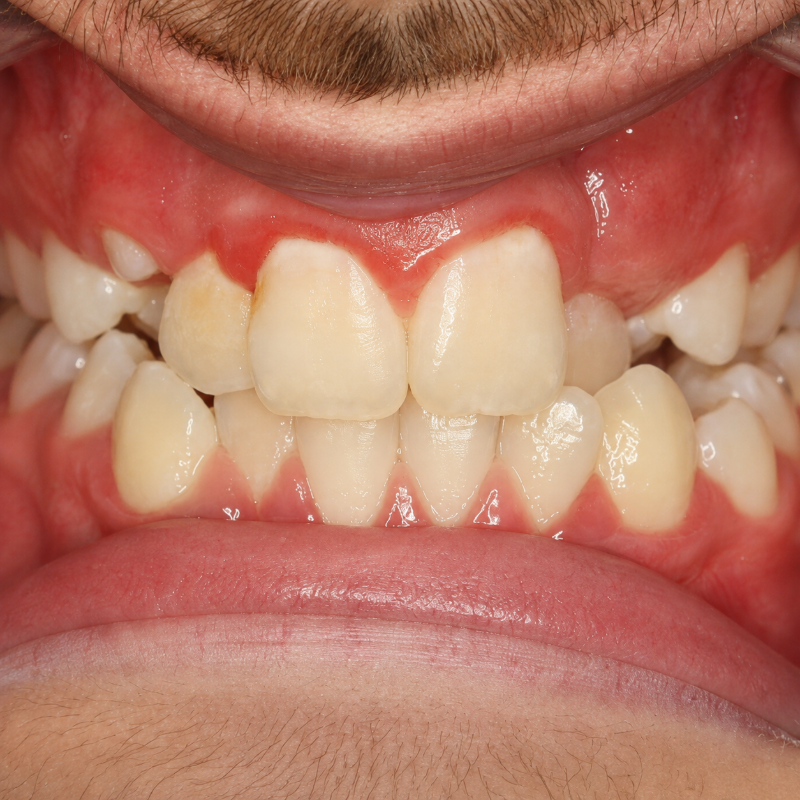 Close-up of a mouth with lips retracted, showing teeth and gums during a dental exam