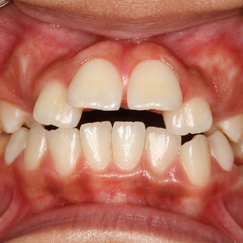 Close-up of a child's mouth showing widely spaced front teeth and pink gums