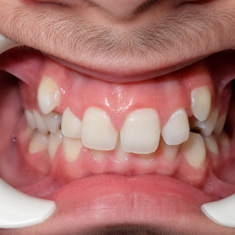 Close-up of a mouth with upper front teeth missing, showing gums and lower teeth.