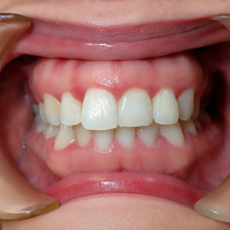 Close-up of smiling mouth showing upper and lower front teeth with cheek retractors