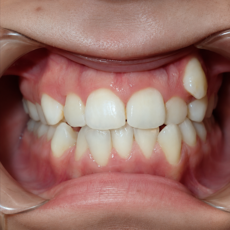 Close-up of a mouth showing teeth and gums with a noticeable gap in the upper front teeth