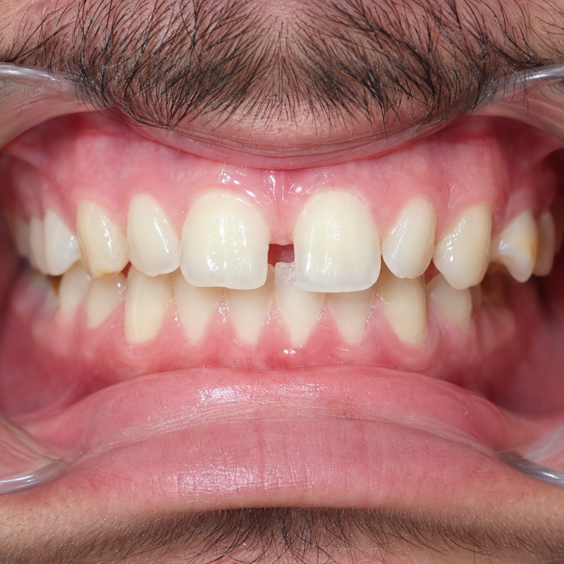 Close-up of a mouth with front teeth showing a gap between the upper incisors