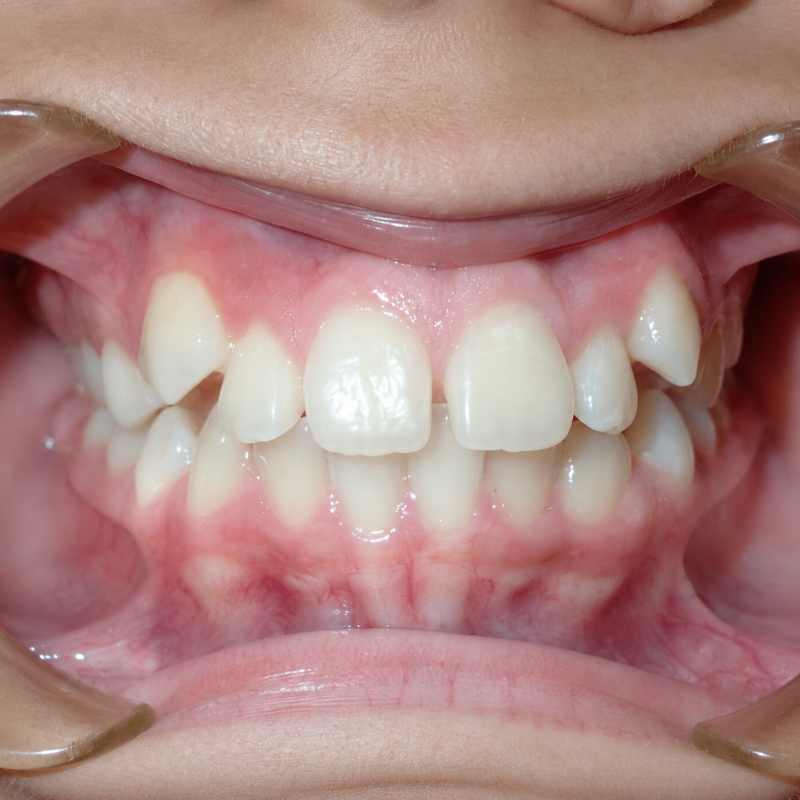 Close-up of a mouth with front teeth showing a gap between the upper incisors