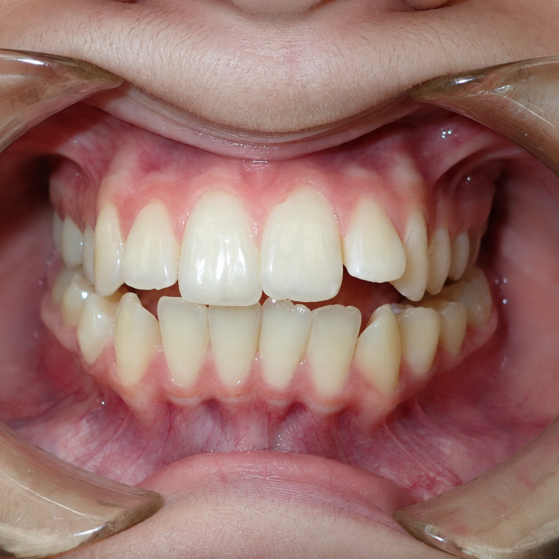 Close-up of a mouth showing teeth and gums with a noticeable gap in the upper front teeth