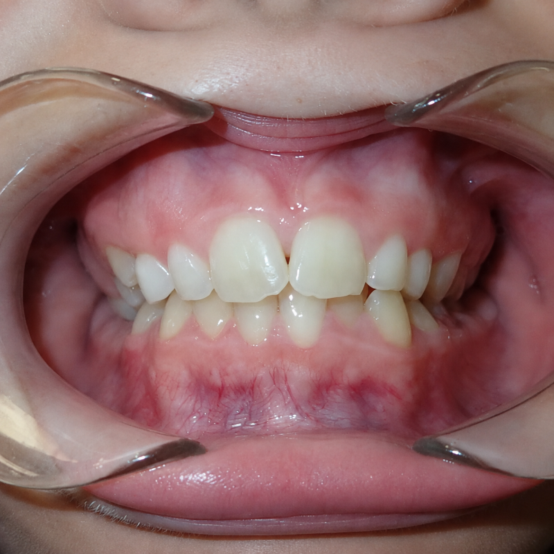 Close-up of a mouth with front teeth showing a gap between the upper incisors