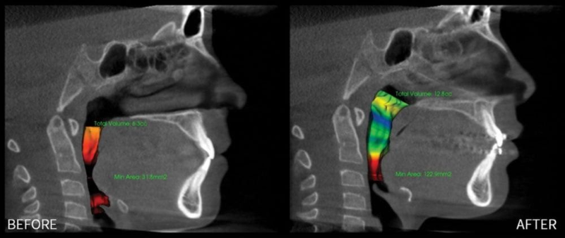 Side-by-side CT scan comparison labeled Before and After, showing colored airway highlights on a patient’s head profile