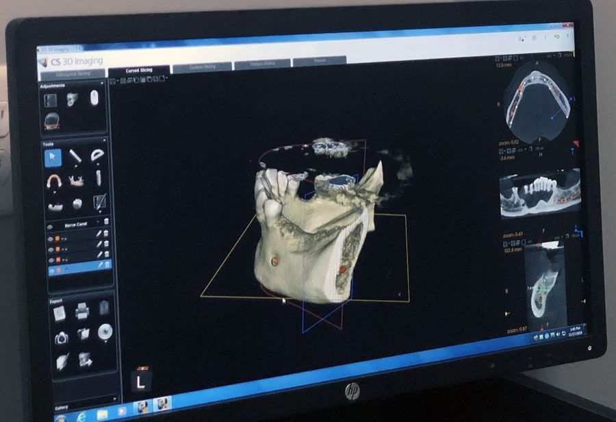 Computer monitor displaying a 3D dental scan on medical imaging software