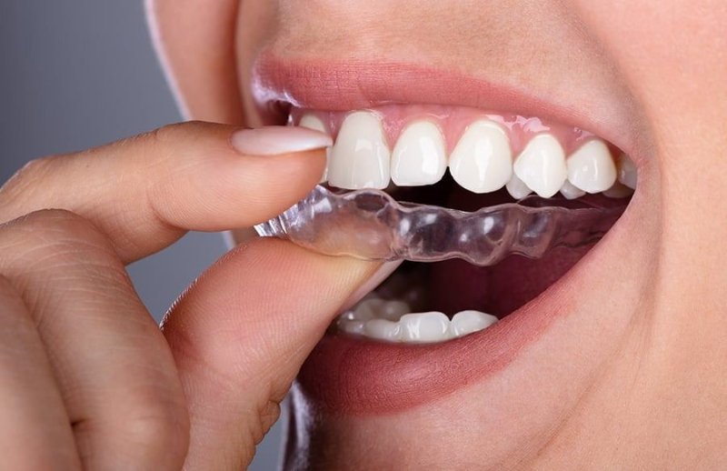 Hand placing a clear dental aligner over upper teeth