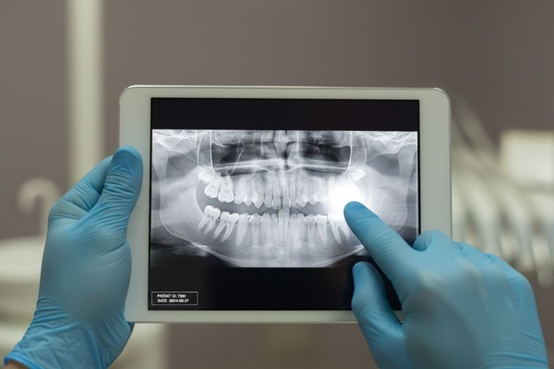 Blue-gloved hands holding a tablet displaying a panoramic dental X-ray
