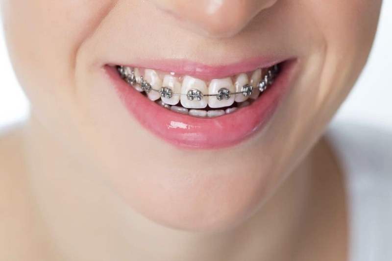 Close-up of a smiling mouth with metal braces and pink lipstick