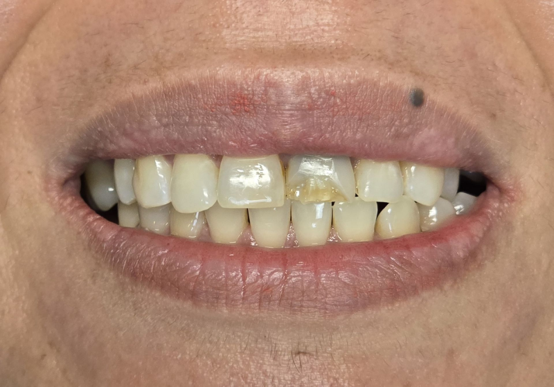 Close-up of a smiling mouth with yellowed teeth and a small dark mark above the upper lip