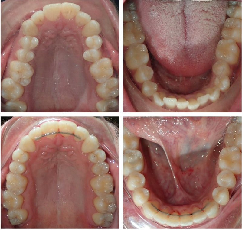 Four close-up photos of a mouth showing upper and lower teeth, tongue, and palate from different angles