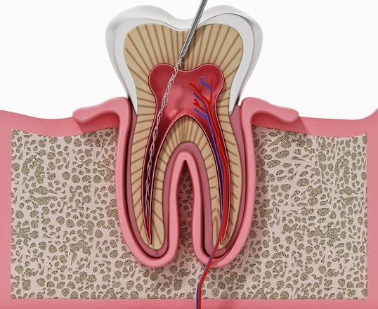 Cross-section of a tooth with root canal treatment instrument inside the root