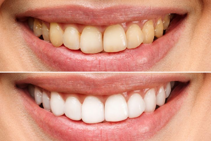 Before-and-after close-up of a smiling mouth with yellowed teeth above and bright white teeth below