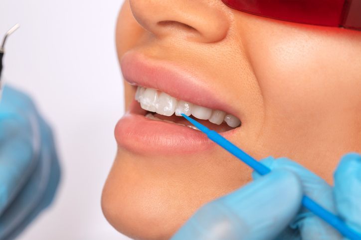 Dentist applying blue dental tool to patient’s teeth during oral exam