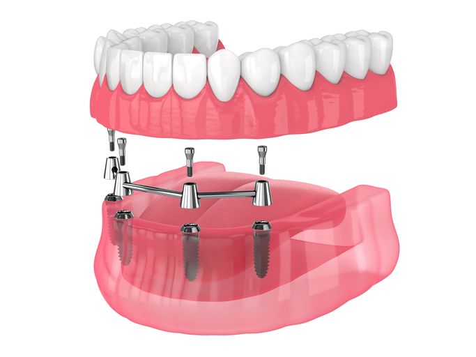 Exploded view of pink upper and lower dentures with metal attachment framework and white teeth