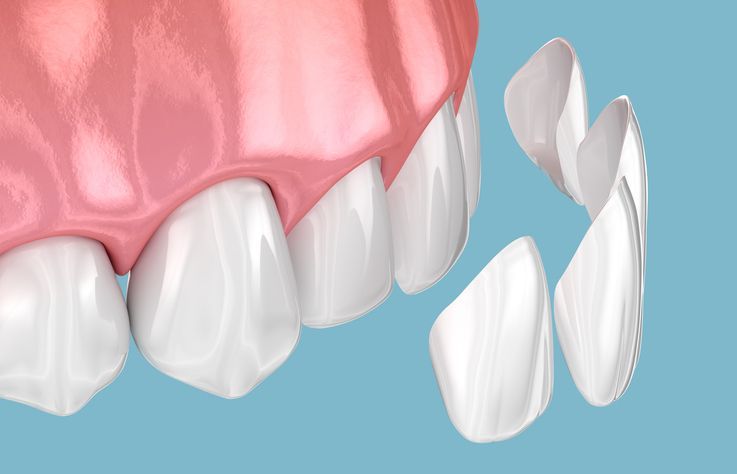 Illustration of a gum and teeth model with several detached white teeth on a blue background
